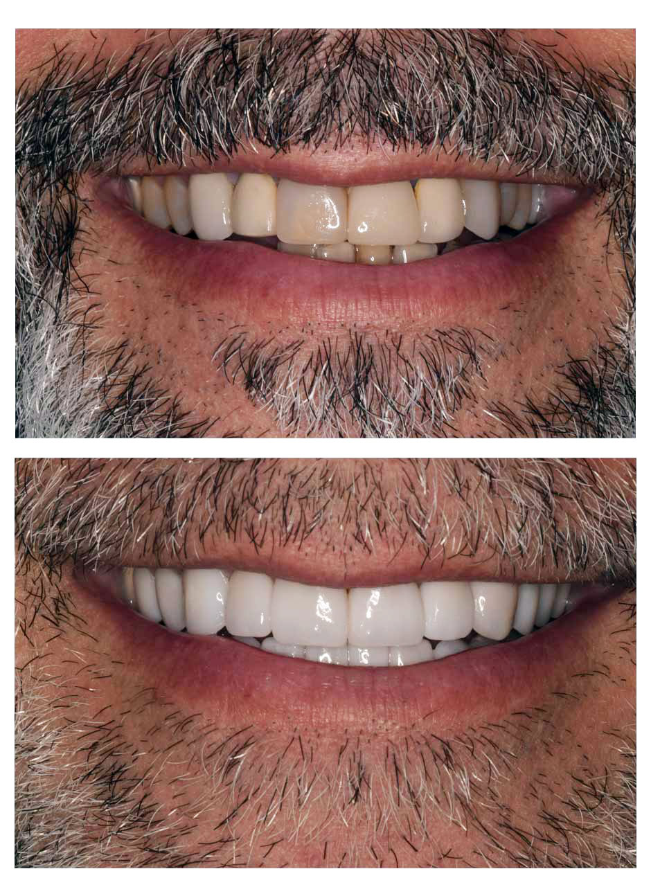 Natural looking veneers results Austin City Dental