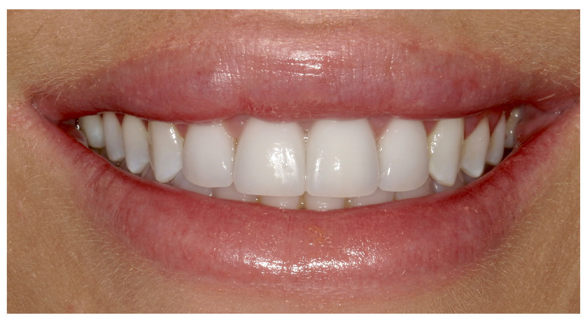 After treatment with an implant crown and three porcelain veneers by Dr. Steve Cook