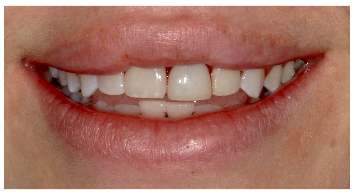 Before treatment showing a fractured front tooth and uneven front tooth proportions