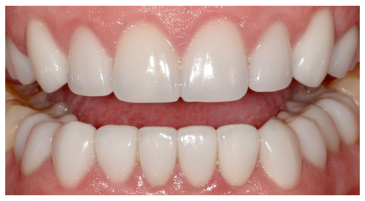 After a gum lift and twenty porcelain veneers by Dr. Steve Cook