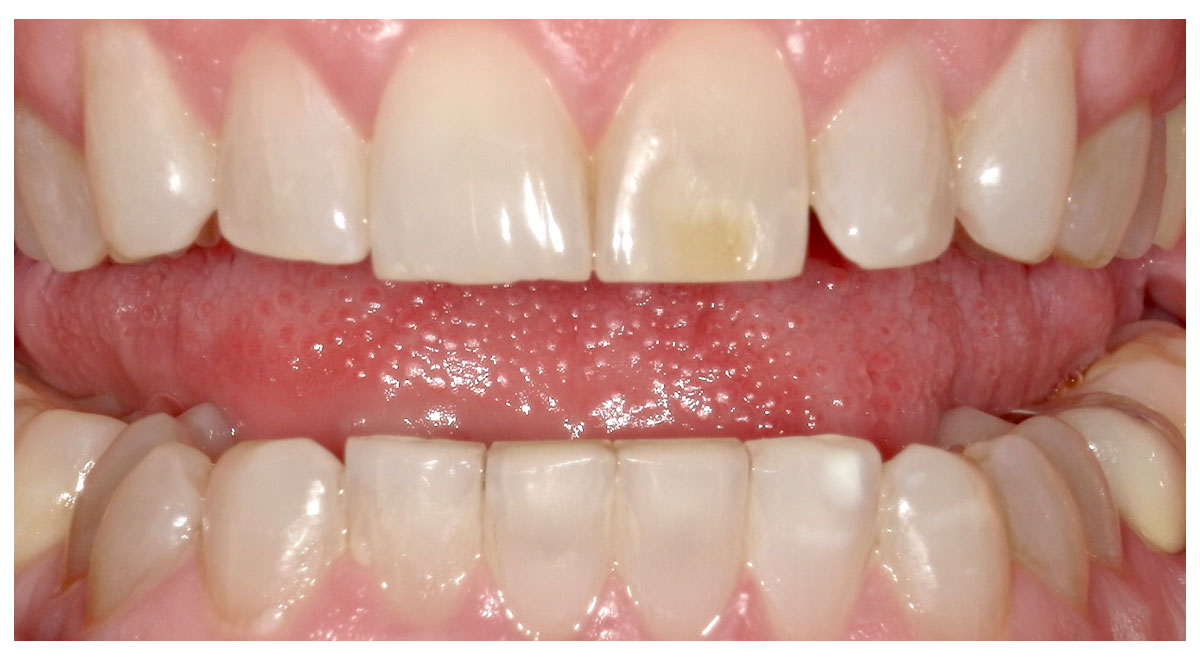Before treatment showing shorter teeth, discoloration, and greater gum display