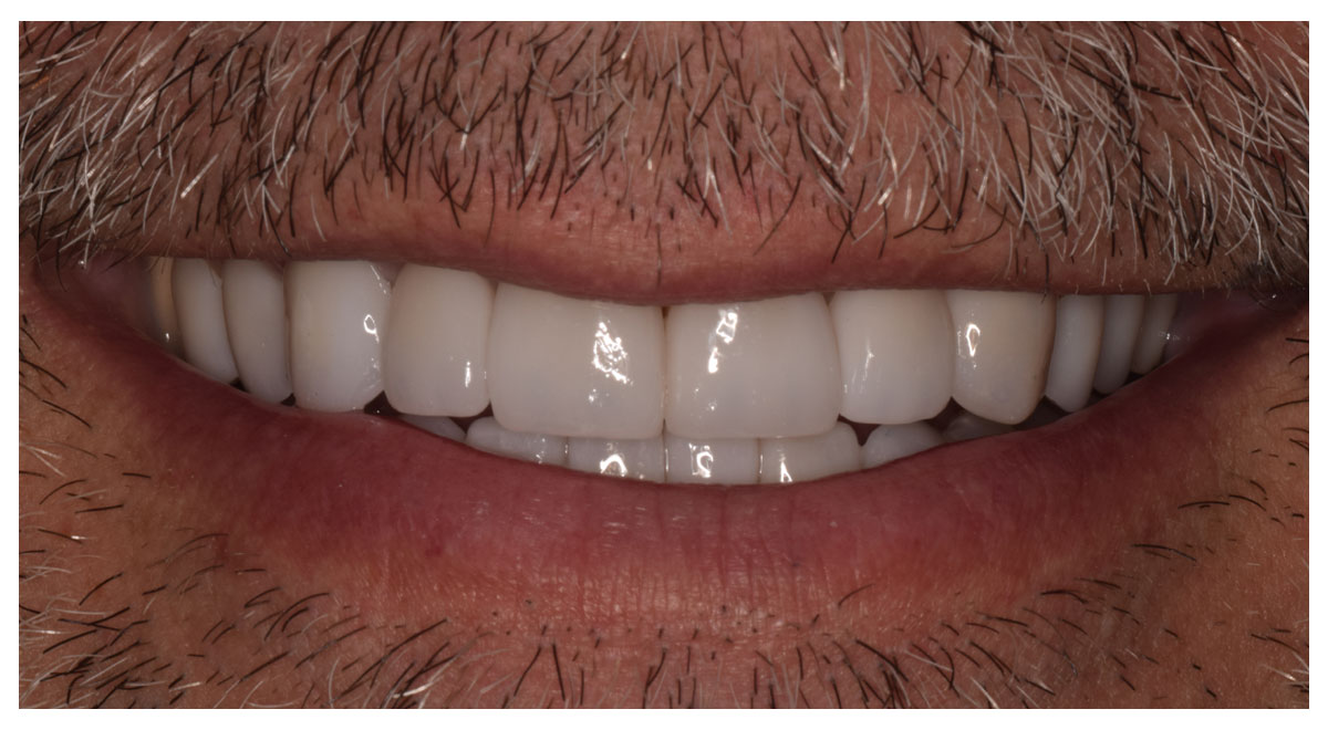 After coordinated treatment with ten porcelain veneers and crowns by Dr. Steve Cook