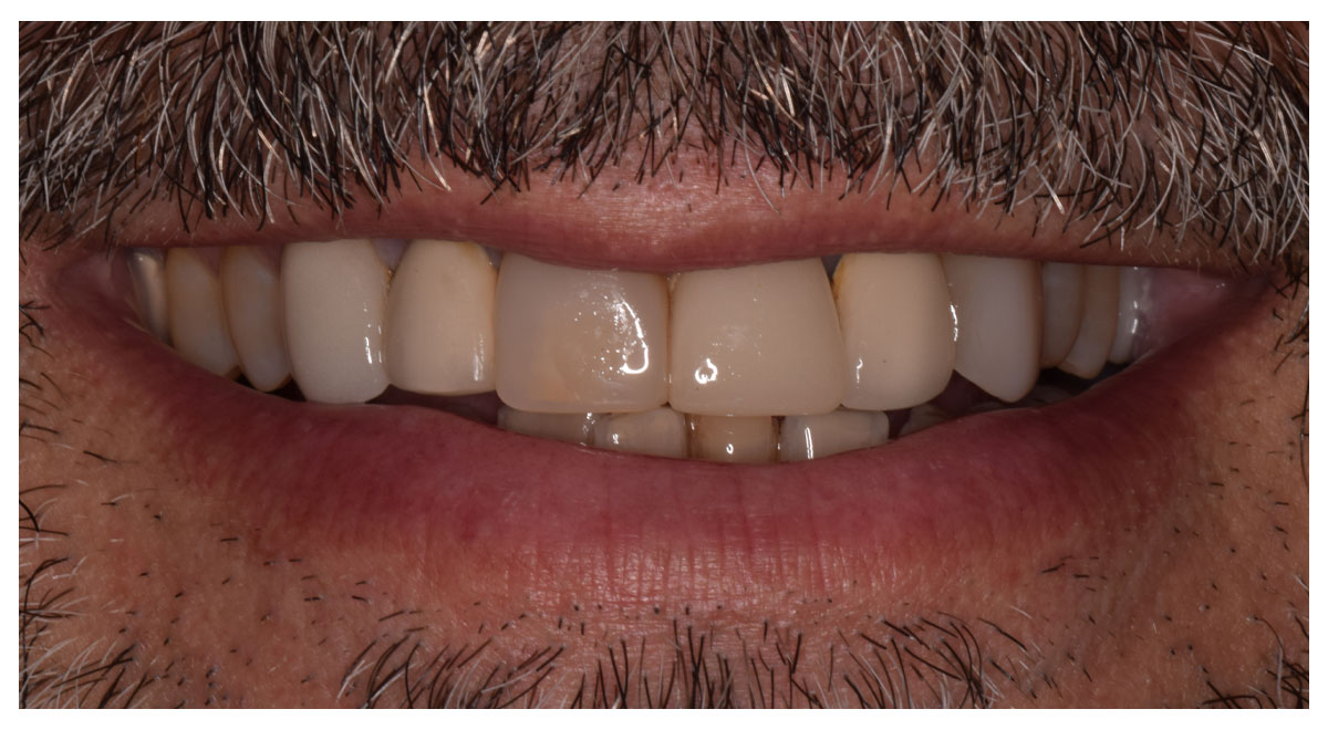 Before treatment showing mismatched shades from older dental bonding and crowns
