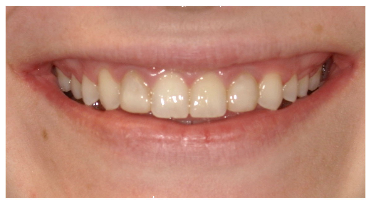 Before porcelain veneers at Austin City Dental, case 9